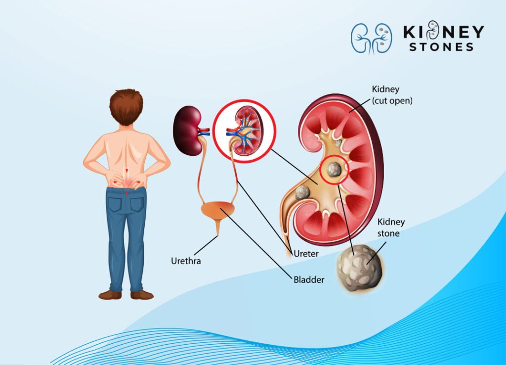 kidney-stone-treatment